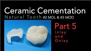 Lithium Disilicate Ceramics Part 5 Cementation of Inlay and Onlay [upl. by Eivlys]