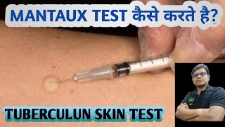 Mantoux test  TST  PPD  Tuberculin skin test  Diagnosis of TB [upl. by Hershel]