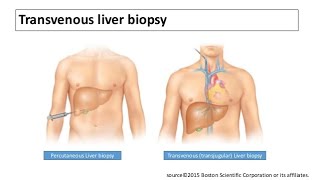 TJLB TransJugular Liver Biopsy procedure in chronic liver disease ascites and low platelets [upl. by Eelannej]