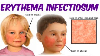 Erythema Infectiosum Fifth Disease [upl. by Ute]