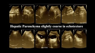 Coarse hepatic parenchymal  Ultrasonography report  liver disease  Amader Hospital  P1 [upl. by Heman]