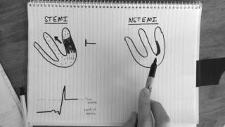 Ischemia 57 Examples of UA and NSTEMI [upl. by Eceela491]