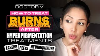 Doctor V  How To Treat Burns after Hyperpigmentation Treatments  Skin of Colour [upl. by Bussy]