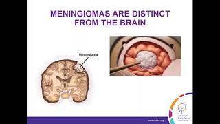 WEBINAR Treatment Strategies for Meningioma [upl. by O'Malley]