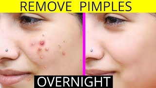 How To Remove Pimples Overnight  Acne Treatment  Anaysa [upl. by Donnell]