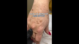 How to remove AGE SPOTS [upl. by Leena]