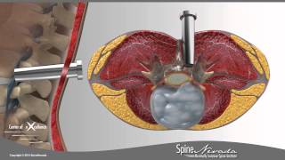 Lumbar Microdiscectomy  Spine Center Northern Nevada Northern California  Spine Surgery [upl. by Meares]