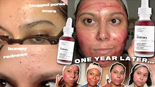 the ordinary peeling solution ONE YEAR results and review [upl. by Llednahc227]