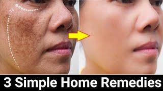 Remove Face Pigmentation Naturally [upl. by Kirch]