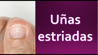 Uñas estriadas ✅ Libérate de preocupaciones [upl. by Elroy552]