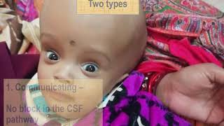 Hydrocephalus in children  Pediatrics [upl. by Royal913]