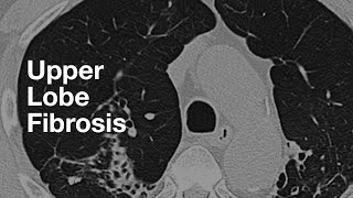 Upper Lung Predominant Fibrosis [upl. by Ulrika407]