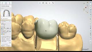 Dental Lab Life Designing a Crown in 3Shape [upl. by Julieta411]