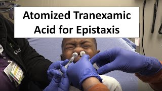 Atomized Tranexamic Acid for Epistaxis Control [upl. by Shelagh463]