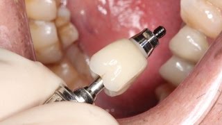 Full Contour Zirconia Implant Crown Insert [upl. by Axe]