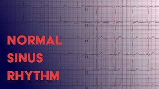 Normal Sinus Rhythm  EKG ECG Interpretation [upl. by Neelrihs]