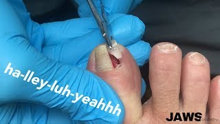 REMOVING A LARGE INGROWN TOENAIL [upl. by Liebman]