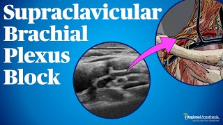 Supraclavicular Brachial Plexus Block [upl. by Nnyleitak]