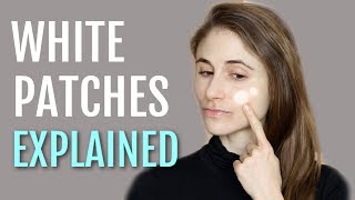 WHITE PATCHES ON THE FACE EXPLAINED PITYRIASIS ALBA DR DRAY [upl. by Hillel]