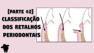 Classificação dos Retalhos Periodontais e Incisões Periodontais  Aula de Cirurgia Periodontal [upl. by Foscalina]