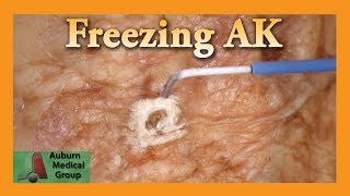 Freezing Hand Actinic Keratosis with Liquid Nitrogen  Auburn Medical Group [upl. by Mossberg754]