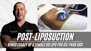 Post Liposuction  Venus Legacy RF  Female HD Lipo  Six Pack  West Hollywood CA  Dr Jason Emer [upl. by Socha]