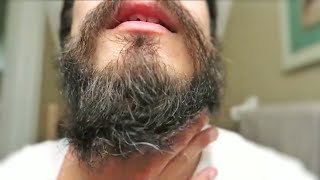 Patchy Beard Growth After 1 YEAR [upl. by Old176]