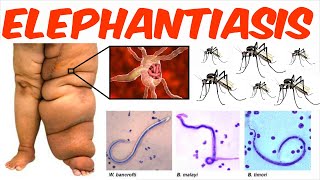 Lymphatic Filariasis  Elephantiasis [upl. by Attenweiler]