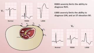 Advanced EKGs  WolffParkinsonWhite WPW Syndrome [upl. by Akit]