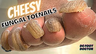 Cheesy Fungal Toenails Trimming Long Toenails [upl. by Elcin]