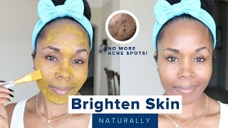 How to Brighten Skin Reduce Acne Scars Hyperpigmentation amp Discoloration  Home Remedies [upl. by Pulchi415]