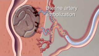 Robotic Laparoscopic Hysterectomy 9 Month Recovery  Wellness [upl. by Anneuq951]