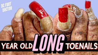 Year Old Long Toenails Trimming Extremely Long Toenails [upl. by Lotz]