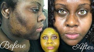 5 DAY TURMERIC FACE MASK CLEARED MY HYPERPIGMENTATION IM SHOOK [upl. by Cindra]