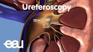 Removal of kidney stones URS [upl. by Aelrac]