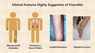 VASCULITIS  VASCULAR PATHOLOGY  Recap [upl. by Higginbotham85]