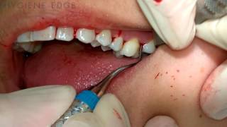 Gracey Instrumentation During Periodontal Therapy [upl. by Ransom]