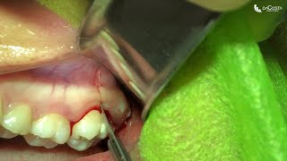 Exodontia de terceiro molar superior Upper wisdom tooth extraction [upl. by Larson]