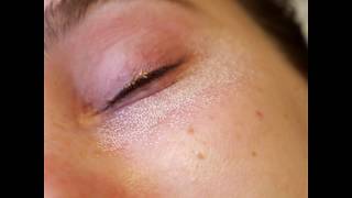 How to GET RID OF UNDER EYE WRINKLES Dr Dray [upl. by Jonny261]