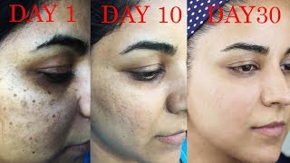 How I Got Rid of Dark Scars Hyperpigmentation PimplesAcne [upl. by Muslim]