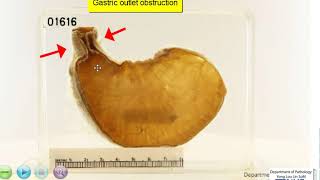 Stomach Congenital hypertrophic pyloric stenosis [upl. by Baer]