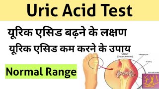 Uric Acid Test in Hindi  uric acid treatment  uric acid symptoms [upl. by Nelleoj253]