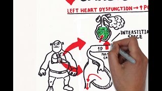 Pulmonary edema USMLE step 1 [upl. by Ayikat578]