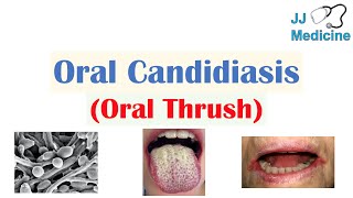 Oral Candidiasis Oral Thrush  Causes Pathophysiology Signs amp Symptoms Diagnosis Treatment [upl. by Goldenberg716]