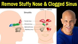 4 Proven Techniques for Stuffy Nose amp Clogged Sinus  Dr Alan Mandell DC [upl. by Lundt]