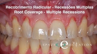 Recobrimento Radicular  Recessões Múltiplas  Root Coverage  Multiple Recessions [upl. by Maurise]