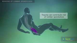 Lumbar Spondylosis Reasons [upl. by Vilhelmina348]