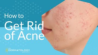 Acne Treatment  Explained by Dermatologist [upl. by Yrhcaz]