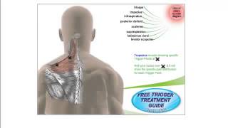 Free Trigger Point Charts [upl. by Garik579]