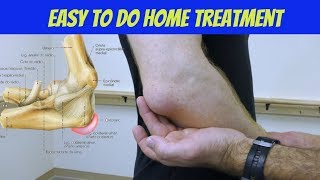 Knee Bursitis  Everything You Need To Know  Dr Nabil Ebraheim [upl. by Maise761]